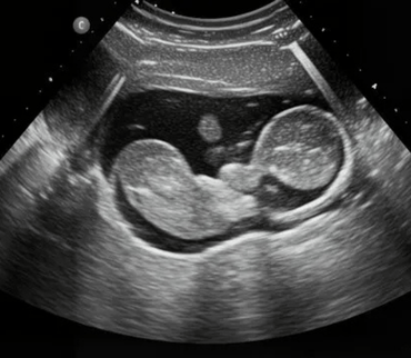 3D And 4D Sonography